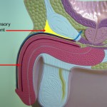 Operasi Membesarkan Penis, Berhasil atau Sia-Sia?