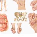 Jenis-Jenis Penyakit Menular Seksual (PMS)