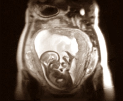 Tes dengan X-Ray Untuk cek kehamilan