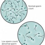 4 Jenis Gangguan Sperma yang Umum Dialami Kaum Pria