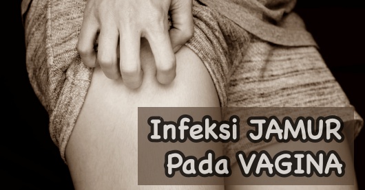 Cara mengobati infeksi jamur pada vagina