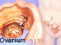 Diagnosa kanker ovarium