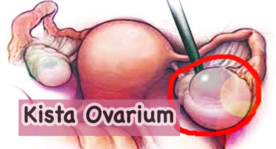 Jenis kista ovarium