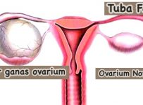 Tanda tumor ovarium menjadi ganas